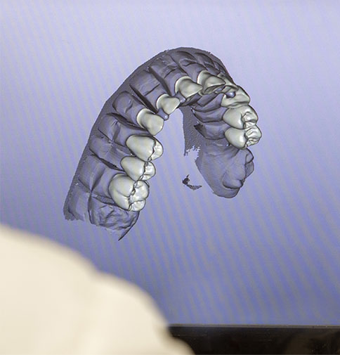 Photo of a dental model of teeth on screen.